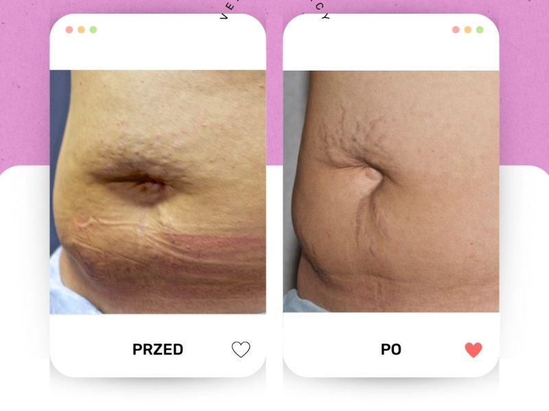 Venus Legacy brzuch 3 PRZED PO