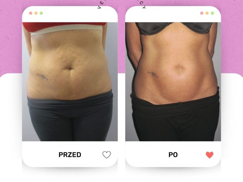 Venus Legacy brzuch PRZED PO