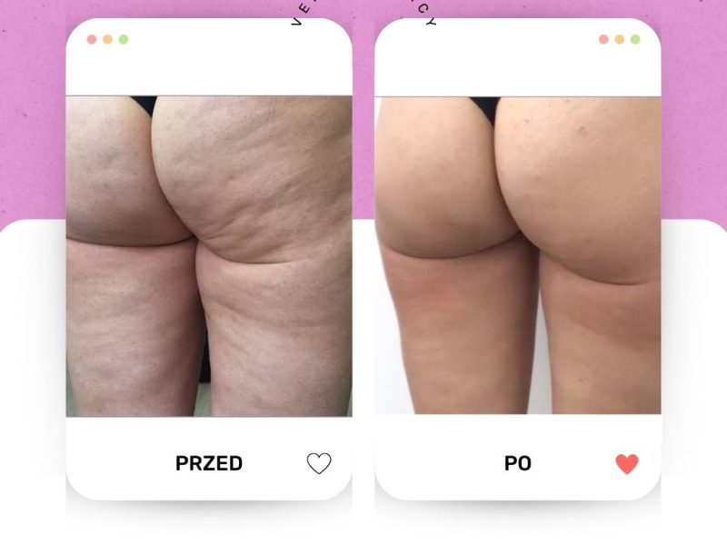 Venus Legacy pośladki 3 PRZED PO