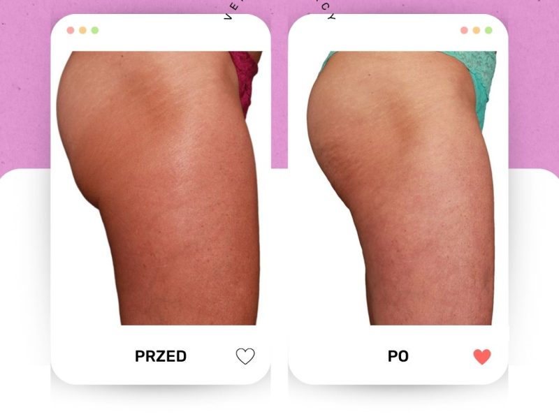 Venus Legacy pośladki PRZED PO