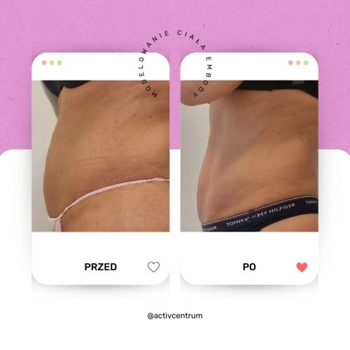 Zabieg EMBody PRZED PO ACTIV Centrum